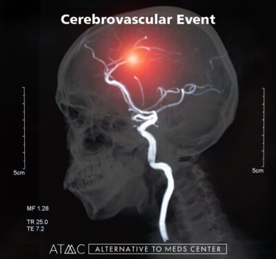 vraylar-induced cerebrovascular event