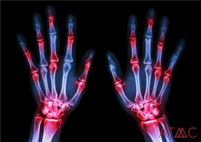 arthritis pain