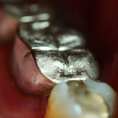 Mercury in Dental Amalgams
