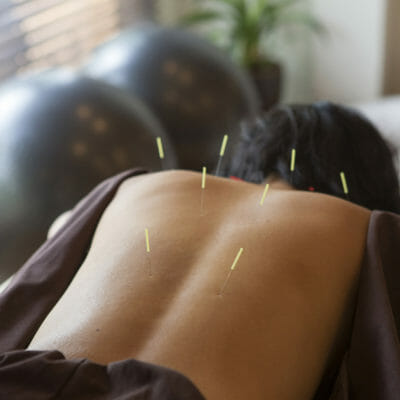 acupuncture 