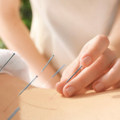 acupuncture