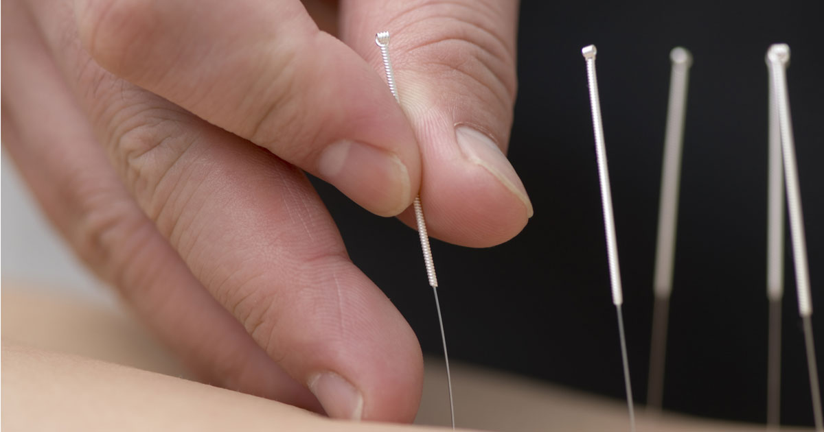  How Long Does It Take For Acupuncture to Work For Depression