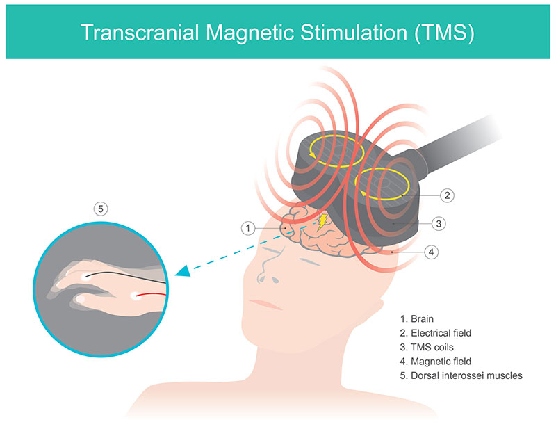 Transcranial Magnetic Stimulation